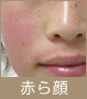 赤ら顔