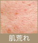 肌荒れ