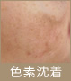 色素沈着